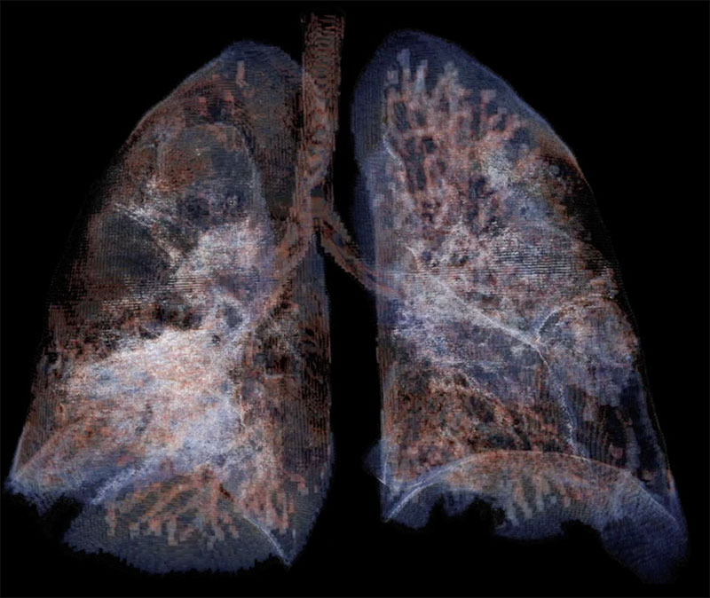 lungs_list